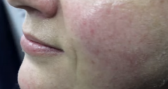 熙凝顏祛斑加盟網(wǎng)帶你了解如何去除雀斑