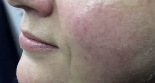 熙凝顏祛斑加盟網(wǎng)帶你了解如何去除雀斑