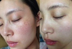 男士如何祛斑熙凝顏祛斑加盟網(wǎng)告訴你