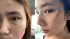 有什么安全祛斑的方法嗎