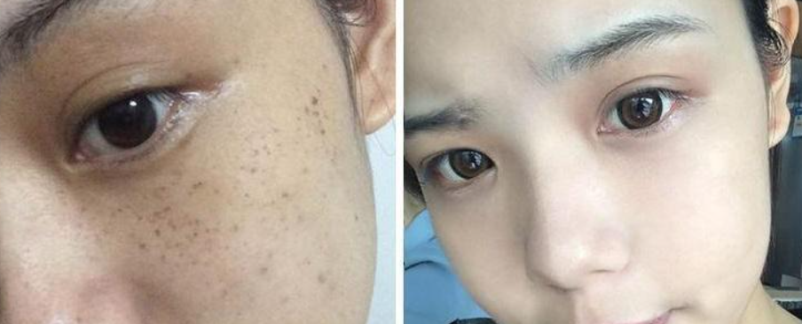 10種祛斑的方法