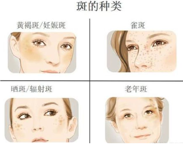 熙凝顏祛斑,淡斑美白還嫩膚